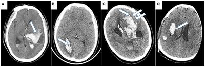 Hematoma Expansion in Intracerebral Hemorrhage: An Update on Prediction and Treatment